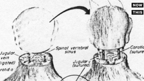 全球首例人类头部移植手术 最快年底进行