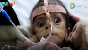 也门5个月大婴儿饿死 曾因身体缺水流不出眼泪