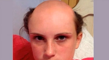 美国女子误把脱毛膏当洗发水 头顶秒变“地中海”？