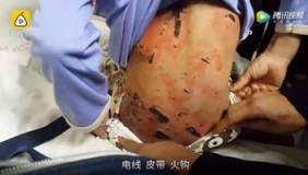 留守男孩被姑父抽打遍体鳞伤 电线皮带火钩都用上了