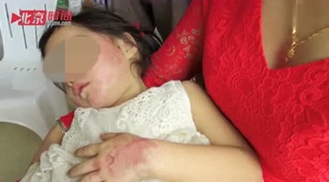  女童被三星手机炸伤毁容