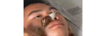 【拍客】奇！男子为美白 竟用活蜗牛“敷脸”