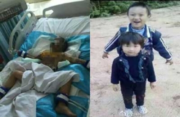 【拍客】湖南两兄妹被同村老人灌浓硫酸 5岁女童死亡