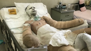 液体酒精再惹祸！两名大学生吃火锅被严重烧伤