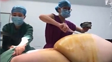 不可思议！厦门250斤孕妇产子，剖腹后医生竟找不到孩子！