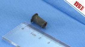 男子咽喉不适 原来肺里有一只藏了20年的口哨