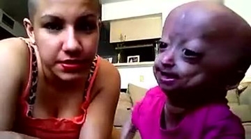 天下奇闻母亲产下双胞胎姐妹，一个美若天仙，一个人其丑无比