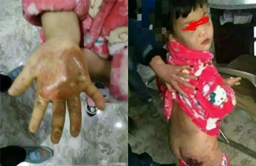 网曝6岁女童遭亲母及情人虐待 双手放开水泡