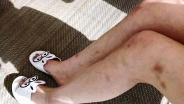 林允瘦身后晒腿部淤青照 网友直呼心疼