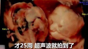 有爱！准妈妈拍超声波竟窥到双胞胎宝宝玩亲亲