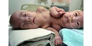 【拍客】新疆连体男婴只有一颗心脏和肝脏