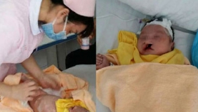 【拍客】男婴被埋10天生还  疑因患兔唇遭父母抛弃