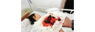 【拍客】升降椅突然爆炸 姑娘下身被击穿碎片嵌入身体