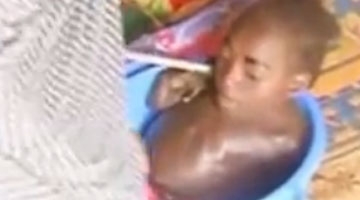 非洲女孩因怪病几乎仅剩头部 一生只能住在盆里