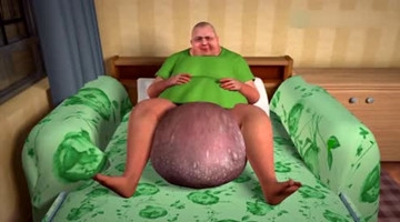 美国男子毛发内生 十年长大成巨型肉瘤