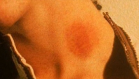 男孩被女友留吻痕 形成血栓丧命