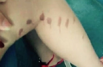 福州多名女孩遭泼不明液体 腿部刺痛留疤痕