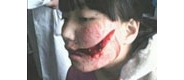 【拍客】女生学校被割脸部缝合30针